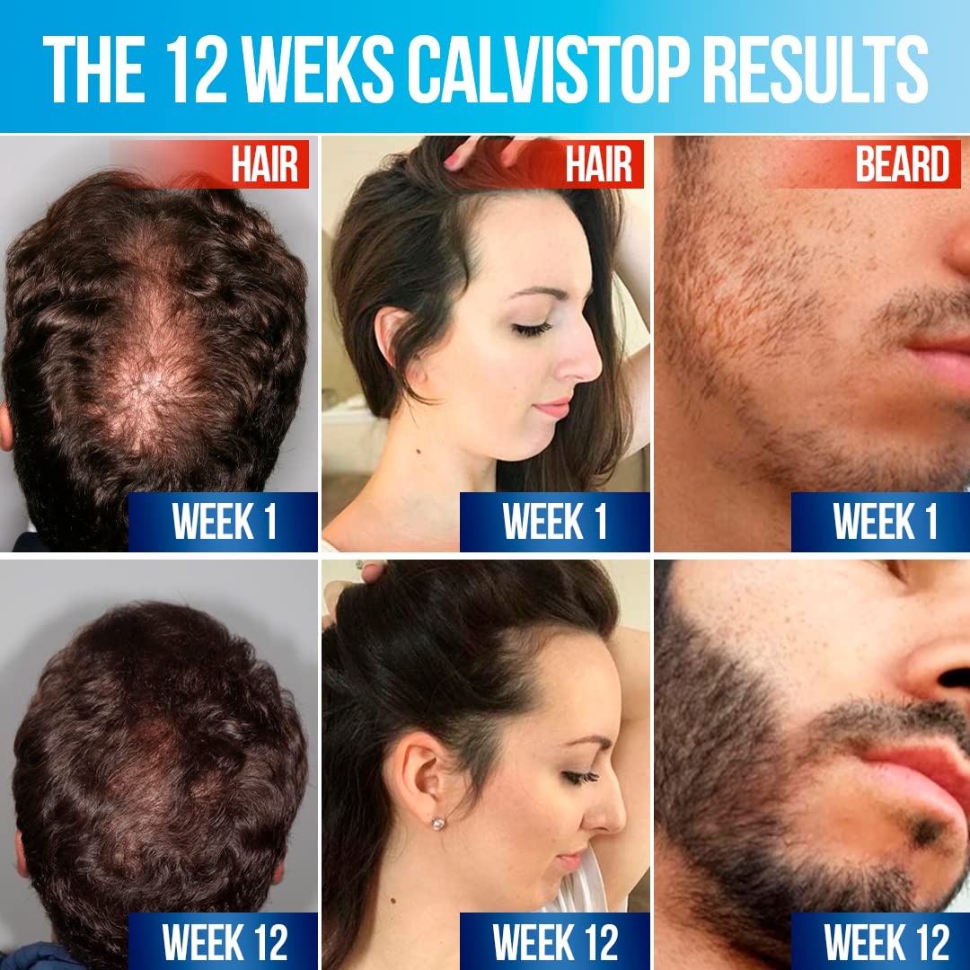 CalviStop Hair Loss Treatment - Stronger, Healthier India | Ubuy CalviStop Hair Loss Treatment - Stronger, Healthier India | Ubuy